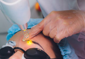 laser skin treatments