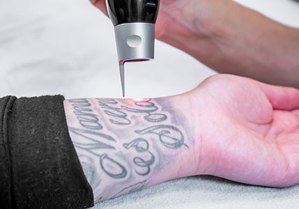 Laser Tattoo Removal Canberra
