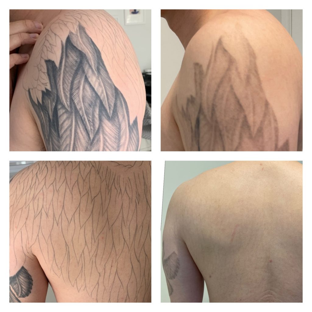 Gallery Laser Tattoo Removal