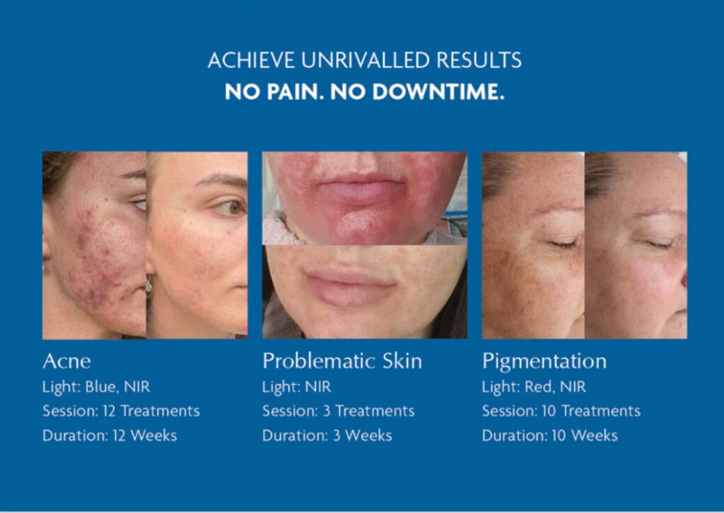 Dermalux LED Light Therapy