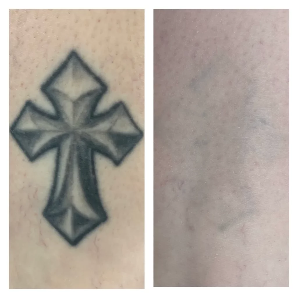 Laser tattoo removal