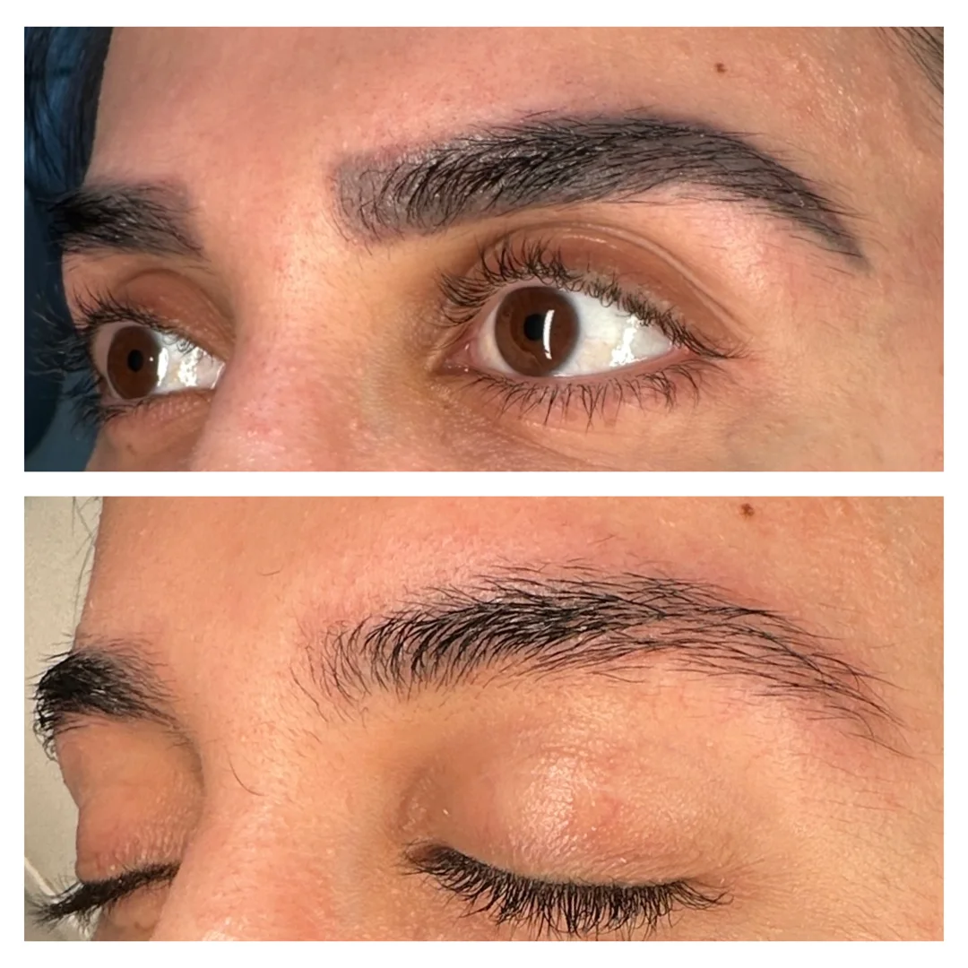 laser tatto removal canberra inya cosmetic clinic